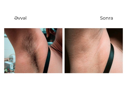 Candela GentleLase Pro-U